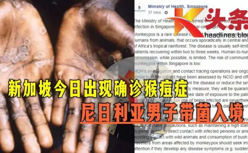 新加坡今日出現確診猴痘症(monkeypox)病例!