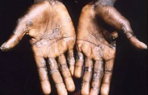 新加坡今日出現確診猴痘症(monkeypox)病例!
