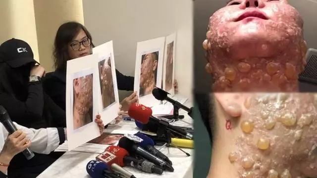 全球首宗 做電波拉皮致二級燒傷毀容
