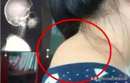 背著「富貴包」可不是真富貴,如何消除?用對方法3招搞定