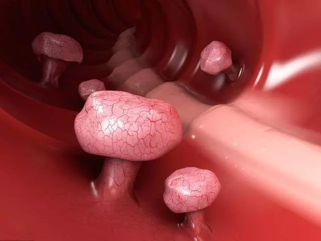 大腸病變的人越來越多,謹記:身體出現【3多2痛】,趕緊去醫院檢查,能保命!