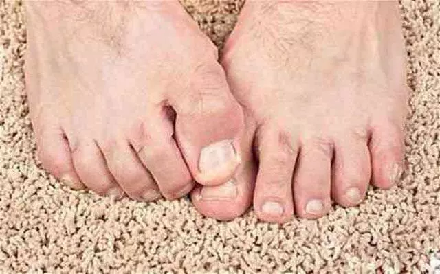 「腎」不好腳知道,如果腳上沒有這三個表現,恭喜你的腎很健康!!