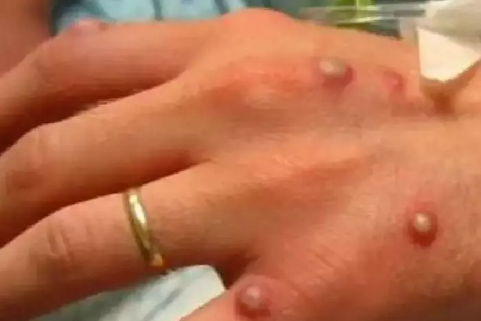 奈及利亞男子帶菌入境 新加坡出現猴痘症 (Monkeypox) 病例 !