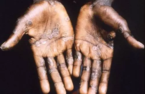 奈及利亞男子帶菌入境 新加坡出現猴痘症 (Monkeypox) 病例 !