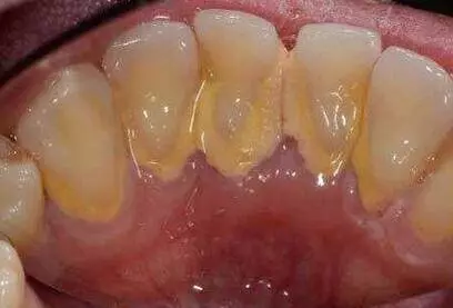 牙垢太多很難清理?教你「8個小竅門」,不用找牙醫,口臭、結石、大黃牙一次都解決!