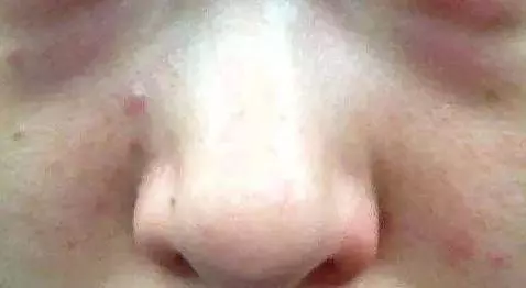 晚上睡不著,易失眠,口幹口苦,警惕肝火過旺,3個小方法降肝火,肝越來越好!!