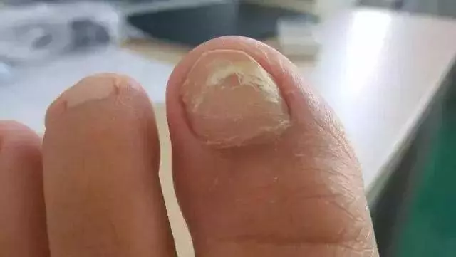 肝不好的人,指甲上會有這5種變化,騙不了人,看一看就知道!