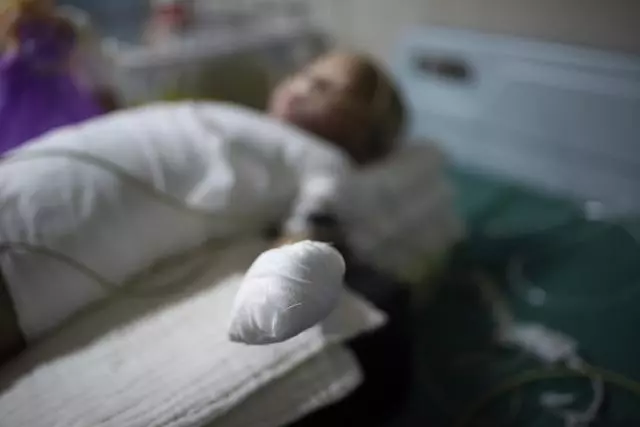 4歲女童全身嚴重燒傷,崩潰痛哭:「哥哥為什麼要拿火燒我」
