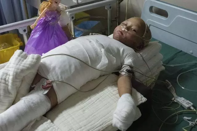 4歲女童全身嚴重燒傷,崩潰痛哭:「哥哥為什麼要拿火燒我」