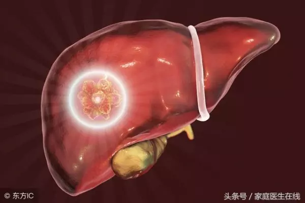 肝臟不會喊痛!肝癌晚期才有症狀,千萬別疏忽!