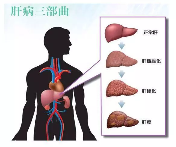 59歲的她患肝硬化,已到無藥可治的階段。她飲用馬鈴薯鮮汁二個月後,體力恢復,已能夠煮飯。現在已經完全康復,可以出外旅行了