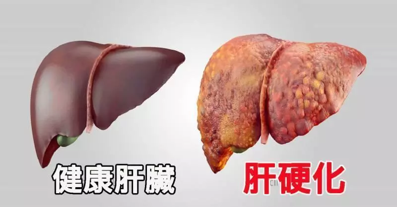 59歲的她患肝硬化,已到無藥可治的階段。她飲用馬鈴薯鮮汁二個月後,體力恢復,已能夠煮飯。現在已經完全康復,可以出外旅行了