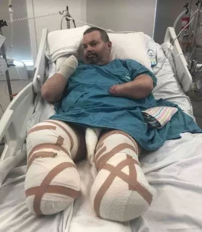 染雙重惡菌 休克命危 一見愛女 活下來