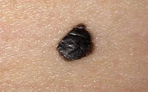 體內有病,皮膚先行?皮膚出現3種「異常」,【病】離你已經很近了