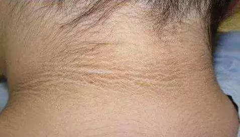 體內有病,皮膚先行?皮膚出現3種「異常」,【病】離你已經很近了