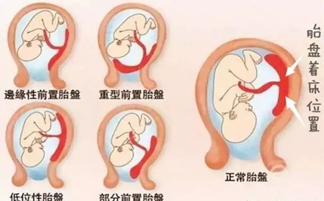 有寶寶後,如果孕媽的肚臍是「凹」進去的形態,那可要恭喜你啦