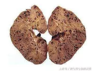 「尿毒症」早期癥狀,10 個人中 6 個都有,快自查!千萬別等無藥可治,只能「洗腎」了!