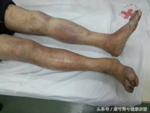 「尿毒症」早期癥狀,10 個人中 6 個都有,快自查!千萬別等無藥可治,只能「洗腎」了!