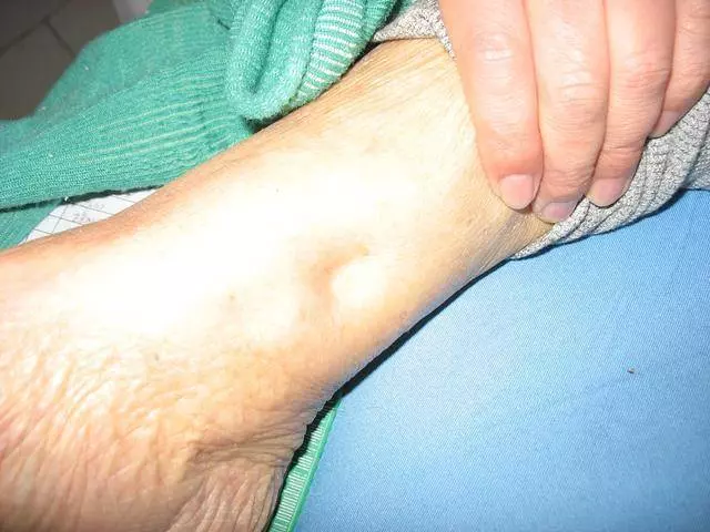 身體出現5大症狀,說明你的血管已經堵塞了,趕緊自查一下