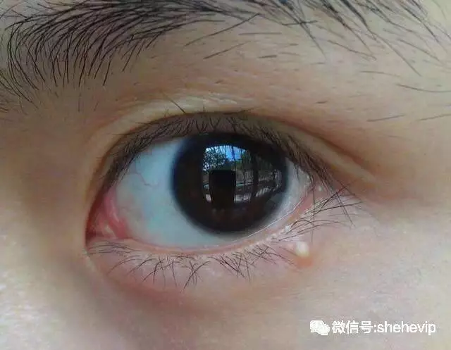 臉上長出了「脂肪粒」不要用手擠,小心被感染!教你「5招」輕鬆去除!!