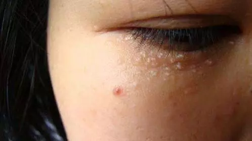 臉上長出了「脂肪粒」不要用手擠,小心被感染!教你「5招」輕鬆去除!!