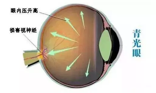 以為眼花看走眼,竟是青光眼前兆,別大意,降眼壓5撇步遠離青光眼