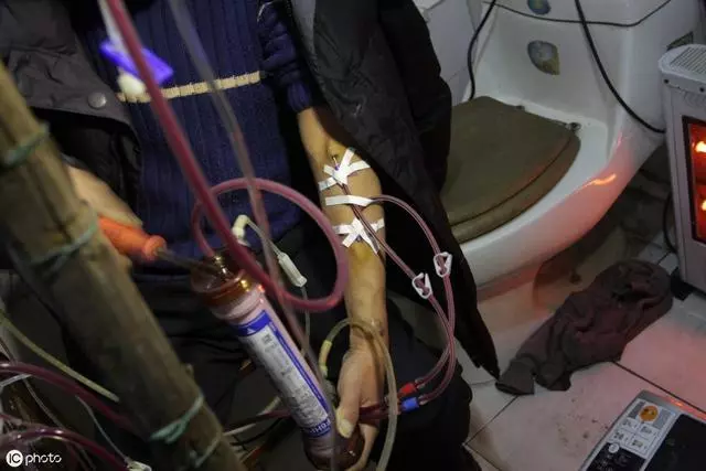 醫生說,高尿酸最嚴重的後果不是痛風?這6物煮水喝,降酸很明顯