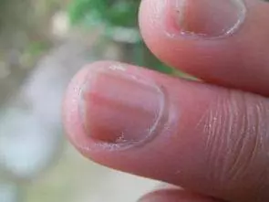 指甲上出現「豎紋」,多數預示著4個問題,可能需要你多加留心
