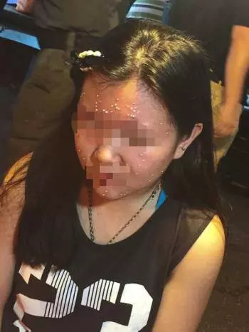 【黑心的點痣師傅!】大馬少女脫痣被砍菜頭,臉上還留下80個黑洞!