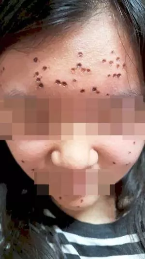 【黑心的點痣師傅!】大馬少女脫痣被砍菜頭,臉上還留下80個黑洞!