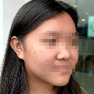 【黑心的點痣師傅!】大馬少女脫痣被砍菜頭,臉上還留下80個黑洞!
