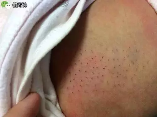 看見寶寶身上長了又多又大的「黑刺」的要小心!千萬別急著拔掉,否則將後悔莫及!