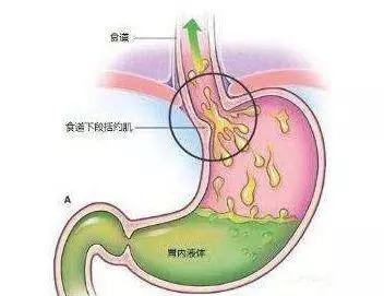 按1按手心窩、再吃10顆花生米,胃反酸、打嗝、噯氣,通通可緩解