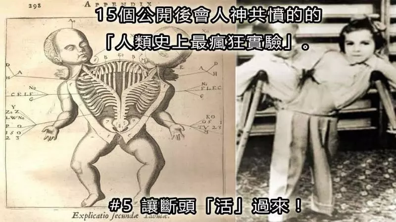 21世紀公開了15個會人神共憤的的「人類史上最瘋狂實驗」。 #14. 在手臂上長出耳朵
