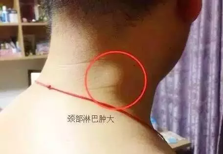 人體三處淋巴決定老年人健康,學會淋巴按摩,隨時隨地能救命