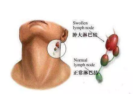 人體三處淋巴決定老年人健康,學會淋巴按摩,隨時隨地能救命