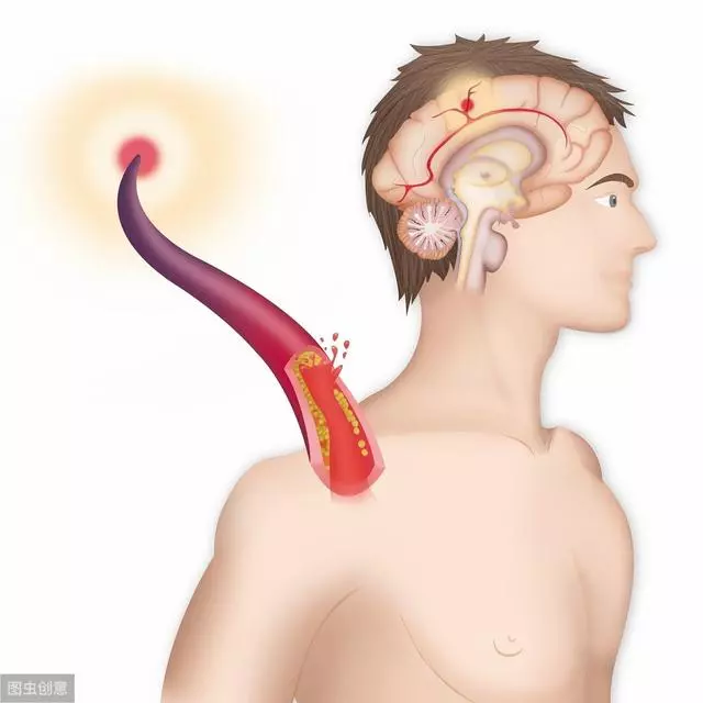早起後,雙手出現2種現象時,是血脂升高了,一個小動作預防血栓