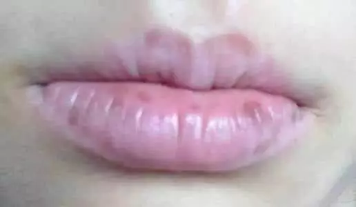 心臟不好的人,臉上會有這4種表現,尤其第三個表現最容易發現,趕緊去檢查吧