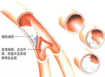 男子連續8天吃了這個,血管竟然清出2瓶「黃油」!而這個你也在經常吃!體型胖的人要注意了!...