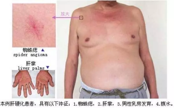 肝硬化,居然有救!!全靠這個~簡直是無價之寶...