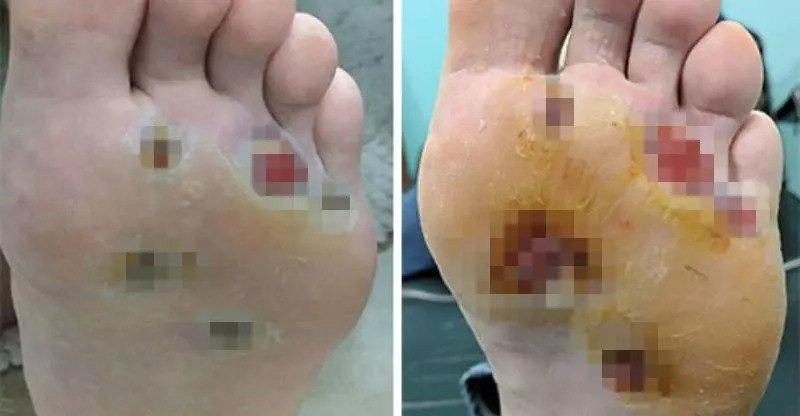 男子在健身房洗澡「忘穿拖鞋」,半年後腳底遭細菌「吃穿5洞」!醫生:再拖就要截肢!