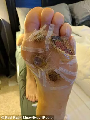 男子在健身房洗澡「忘穿拖鞋」,半年後腳底遭細菌「吃穿5洞」!醫生:再拖就要截肢!