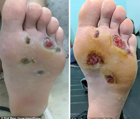 男子在健身房洗澡「忘穿拖鞋」,半年後腳底遭細菌「吃穿5洞」!醫生:再拖就要截肢!