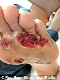 男子在健身房洗澡「忘穿拖鞋」,半年後腳底遭細菌「吃穿5洞」!醫生:再拖就要截肢!