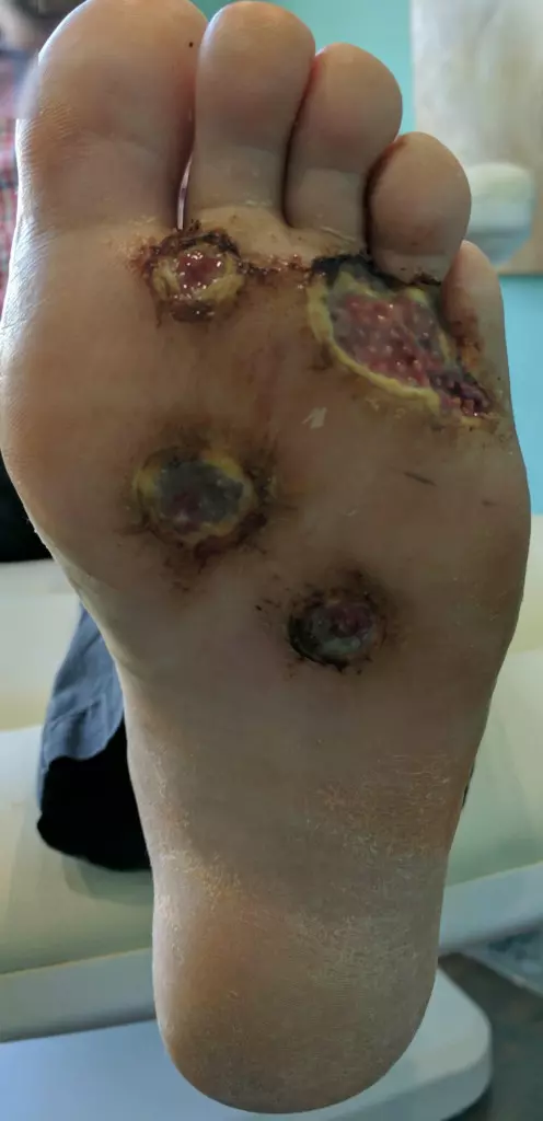 男子在健身房洗澡「忘穿拖鞋」,半年後腳底遭細菌「吃穿5洞」!醫生:再拖就要截肢!