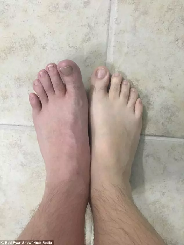 男子在健身房洗澡「忘穿拖鞋」,半年後腳底遭細菌「吃穿5洞」!醫生:再拖就要截肢!