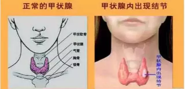甲狀腺結節手術泛濫!良性結節率95%,多數「開了不該開的刀」