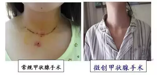甲狀腺結節手術泛濫!良性結節率95%,多數「開了不該開的刀」