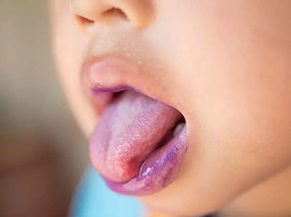 家長注意!春夏為「腸病毒」好發季,尤其「71型」來勢洶洶!疾管署呼籲:出現症狀立馬就醫!