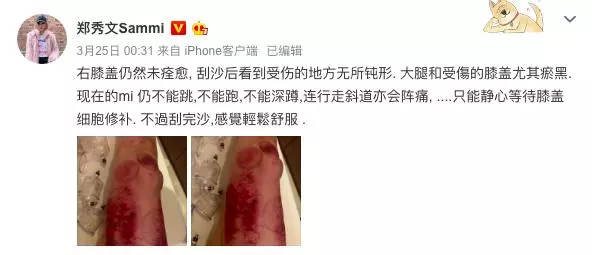 鄭秀文近照曝光現疲態,舊傷復發難掩低迷,狀態惹粉絲心疼~~~